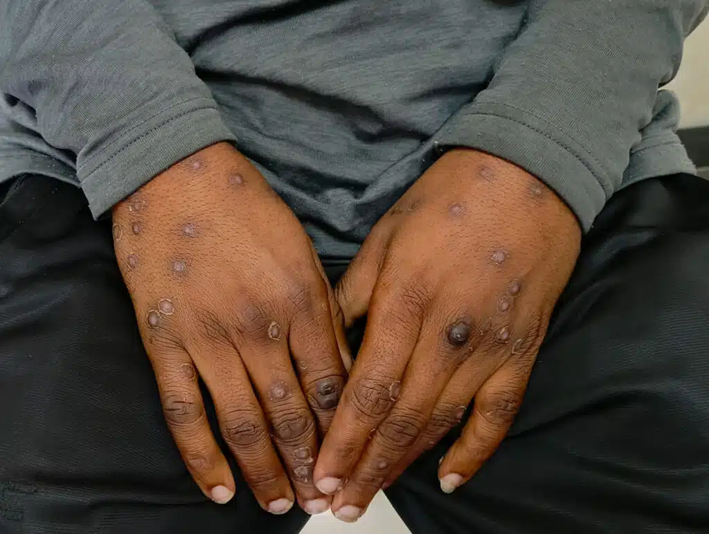 Mpox-Virus