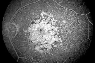 Abb. 2: altersabhängige Makuladegeneration