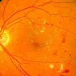 Therapeutische Laserbehandlung vorher